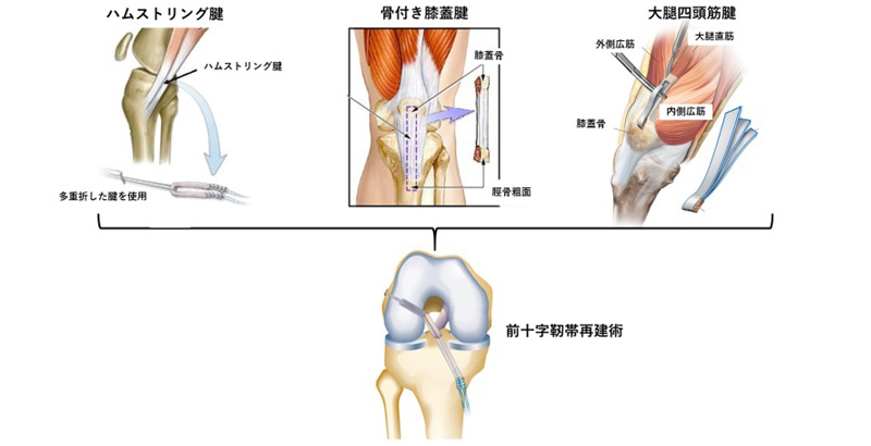 ハムストリング腱や大腿四頭筋腱