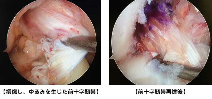 ACL損傷膝・靭帯再建膝