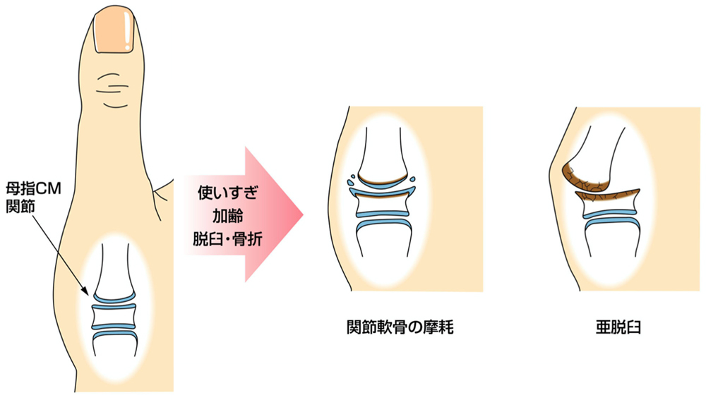 母指CM関節症