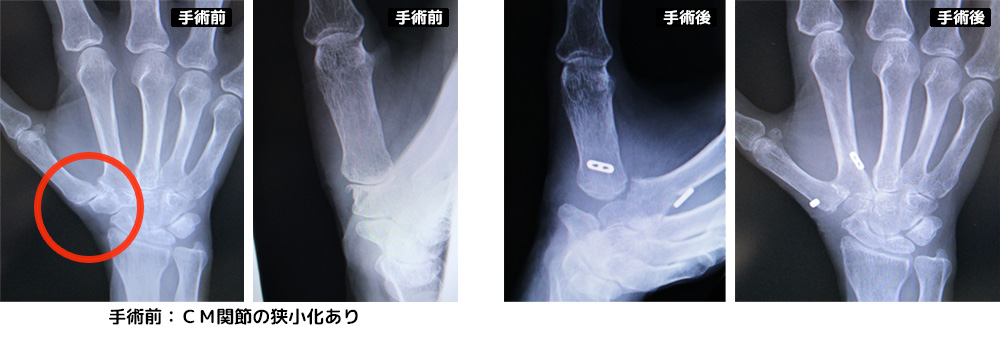 母指CM関節症