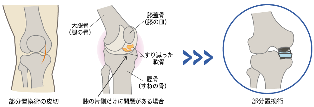 部分置換術・部分置換型