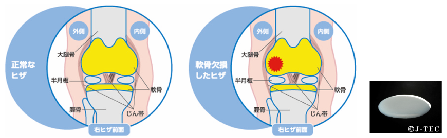 自家培養軟骨移植術とは