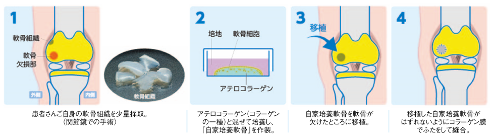 自家培養軟骨移植術の手順