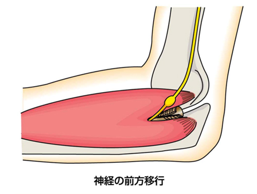 肘部管症候群