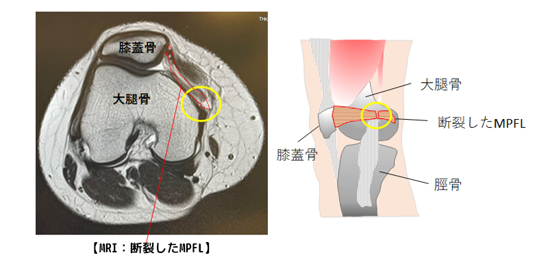 膝蓋骨脱臼