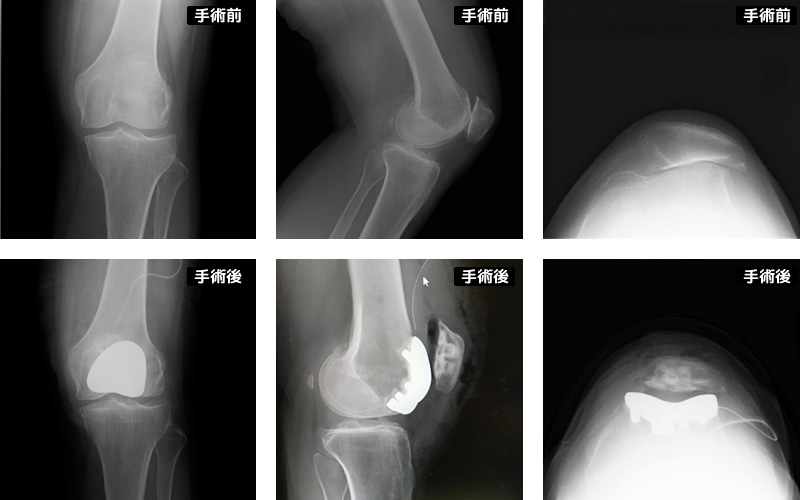 膝蓋大腿骨関節置換術