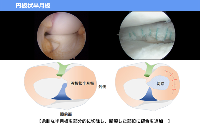 円板状半月板