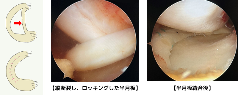 半月板縫合