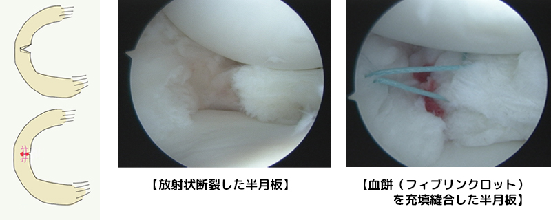 血餅フィブリンクロットを充填合した半月板