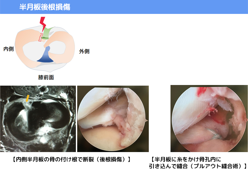 半月板後根損傷