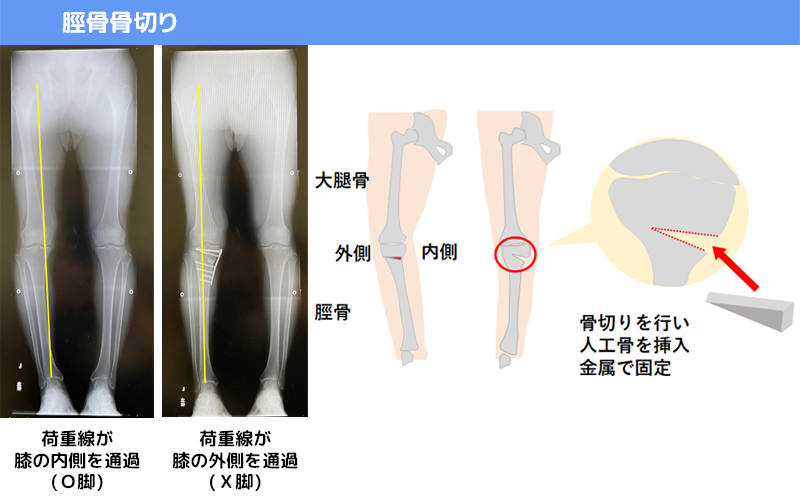 脛骨骨切り