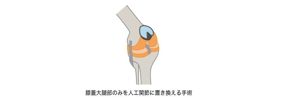 膝蓋大腿関節置換術