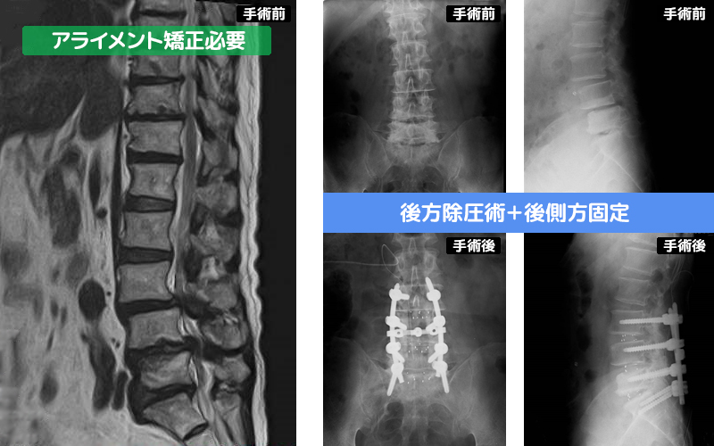 狭窄症