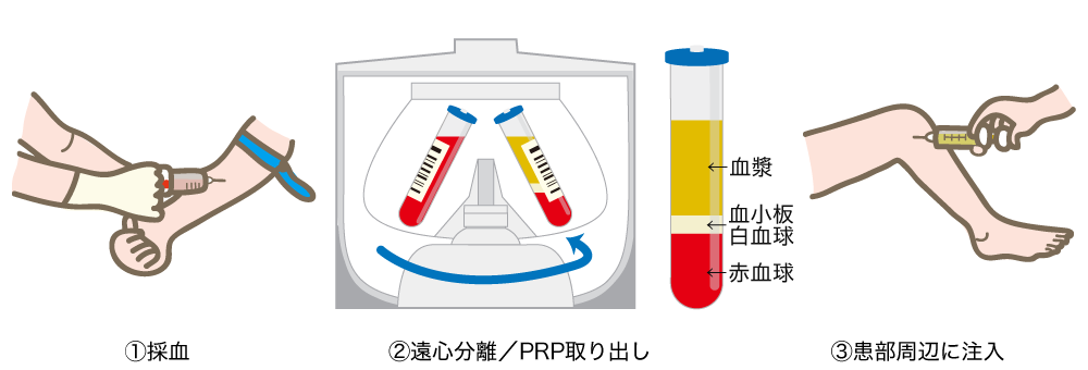 PRP療法