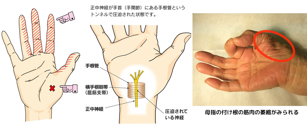 手根管症候群