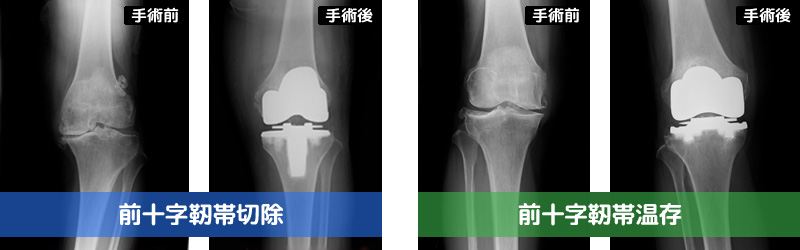 人工膝関節全置換術