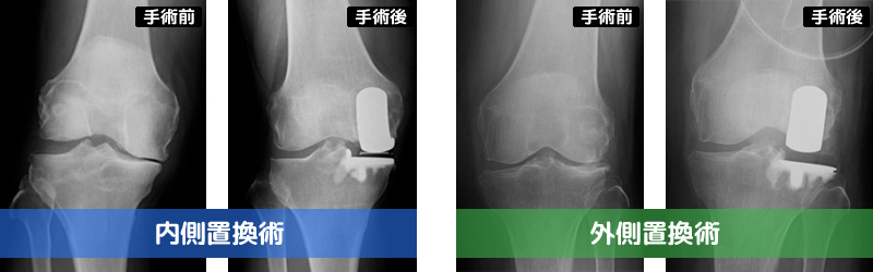 人工膝関節部分置換術