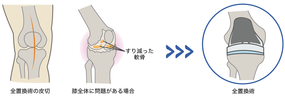 全置換術・全置換型