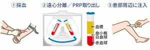 PRP治療の流れ